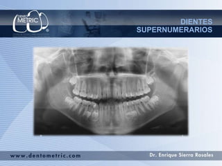 DIENTES
SUPERNUMERARIOS
 
