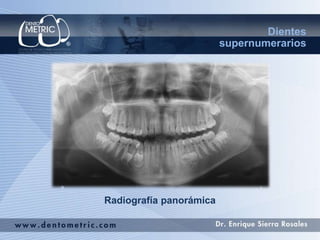 Radiografía panorámica
Dientes
supernumerarios
 