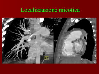 Localizzazione micotica 