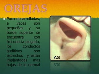  Poco desarrolladas,
a veces son
pequeñas y su
borde superior se
encuentra con
frecuencia plegado,
los conductos
auditivos son
estrechos y están
implantadas mas
bajas de lo normal
 