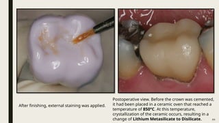 44
After finishing, external staining was applied.
Postoperative view. Before the crown was cemented,
it had been placed in a ceramic oven that reached a
temperature of 850°C. At this temperature,
crystallization of the ceramic occurs, resulting in a
change of Lithium Metasilicate to Disilicate.
 