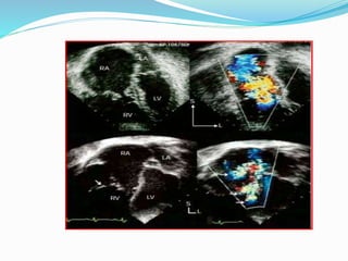 Ebstein's anomaly echocardiogram