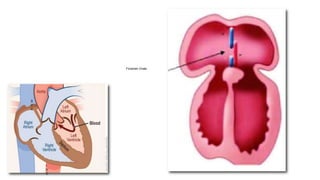 Foramen Ovale
SP
SS
S
V
C
I
V
C
 
