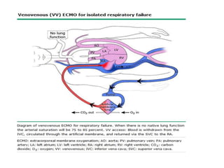 ECMO