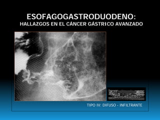 ESOFAGOGASTRODUODENO:
HALLAZGOS EN EL CÁNCER GÁSTRICO AVANZADO
TIPO IV: DIFUSO - INFILTRANTE
 