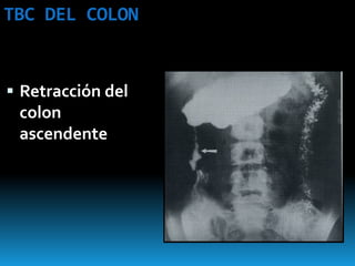 TBC DEL COLON
 Retracción del
colon
ascendente
 