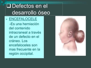 Defectos en el
desarrollo óseo
 ENCEFALOCELE
-Es una herniación
del contenido
intracraneal a través
de un defecto en el
cráneo. Los
encefaloceles son
mas frecuente en la
región occipital.
 