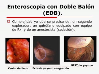Enteroscopia con Doble Balón   (EDB). Complejidad ya que se precisa de: un segundo explorador, un quirófano equipado con equipo de Rx. y de un anestesista (sedación). GIST de yeyuno Crohn de ileon Ectasia yeyuno sangrando 