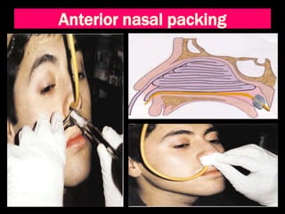 Anterior nasal packing
 
