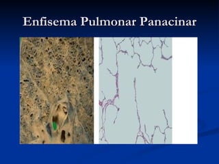 Enfisema Pulmonar Panacinar 