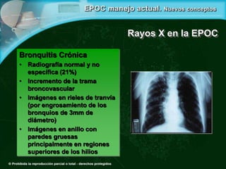 Rayos X en la EPOC
Bronquitis Crónica
• Radiografía normal y no
específica (21%)
• Incremento de la trama
broncovascular
• Imágenes en rieles de tranvía
(por engrosamiento de los
bronquios de 3mm de
diámetro)
• Imágenes en anillo con
paredes gruesas
principalmente en regiones
superiores de los hilios
 