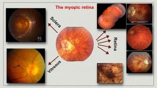 The myopic retina
Retina
 