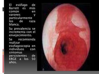 El esófago de
Barrett es más
común
en
varones
y
particularmente
los
de
raza
blanca.
Su prevalencia se
incrementa con el
envejecimiento.
Se
recomienda
realizar
esofagoscopia en
individuos
con
síntomas
persistentes
de
ERGE a los 50
años.

 