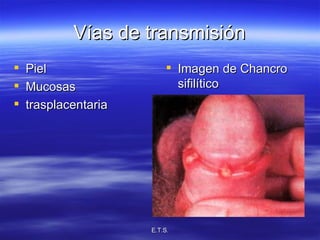 Vías de transmisión Piel Mucosas trasplacentaria Imagen de Chancro sifilítico 
