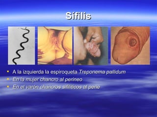 Sífilis A la izquierda la  espiroqueta  Treponema pallidum En la mujer chancro al perineo En el varón chancros sifilíticos al pene 