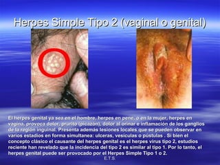 Herpes Simple Tipo 2 (vaginal o genital) El herpes genital ya sea en el hombre, herpes en pene, o en la mujer, herpes en vagina, provoca dolor, prurito (picazón), dolor al orinar e inflamación de los ganglios de la región inguinal. Presenta además lesiones locales que se pueden observar en varios estadios en forma simultanea: ulceras, vesículas o pústulas . Si bien el concepto clásico el causante del herpes genital es el herpes virus tipo 2, estudios reciente han revelado que la incidencia del tipo 2 es similar al tipo 1. Por lo tanto, el herpes genital puede ser provocado por el Herpes Simple Tipo 1 o 2. 