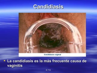 Candidiasis La candidiasis es la más frecuente causa de vaginitis 