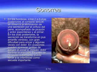 Gonorrea En los hombres, a los 2 a 5 días posteriores al contacto sexual, se observa la eliminación de una secreción por el orificio del pene, acompañado de picazón y ardor espontáneo y al orinar. En los días posteriores, la secreción se transforma en pus amarillo verdoso, con gran dificultad para orinar y algunas veces con dolor. En ocasiones pueden aparecer gotitas de sangre al orinar e, incluso, dolor durante la erección. En caso de no recibir tratamiento puede llevar a la infertilidad como secuela importante.  