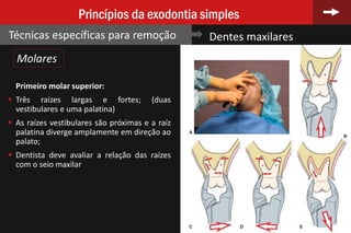 75
Princípios da exodontia simples
Técnicas específicas para remoção Dentes maxilares
Molares
Primeiro molar superior:
 Três raízes largas e fortes; (duas
vestibulares e uma palatina)
 As raízes vestibulares são próximas e a raíz
palatina diverge amplamente em direção ao
palato;
 Dentista deve avaliar a relação das raízes
com o seio maxilar
 