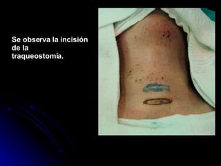 Se observa la incisión de la traqueostomía. 