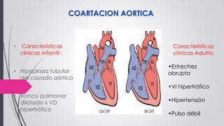 • Características
clínicas infantil :
• Hipoplasia tubular
del cayado aórtico
• Tronco pulmonar
dilatado x VD
hipertrófico
Características
clínicas Adulto:
•Estrechez
abrupta
•VI hipertrófico
•Hipertensión
•Pulso débil
COARTACION AORTICA
 