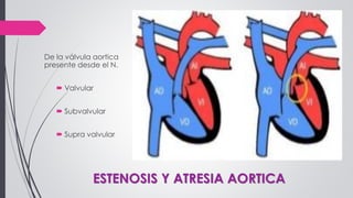 ESTENOSIS Y ATRESIA AORTICA
De la válvula aortica
presente desde el N.
 Valvular
 Subvalvular
 Supra valvular
 