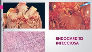 ENDOCARDITIS
INFECCIOSA
 
