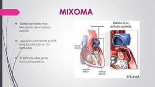 MIXOMA
 Tumor primario mas
frecuente del corazón
adulto.
 Aproximadamente el 90%
está localizado en las
aurículas.
 El 80% de ellos en la
aurícula izquierda.
 