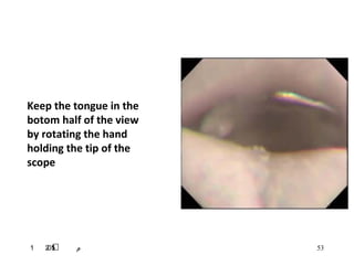 : ‫م‬1 2051 ‫م‬ 53
Keep the tongue in the
botom half of the view
by rotating the hand
holding the tip of the
scope
 