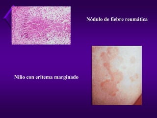 Fiebre Reumatica[1]
