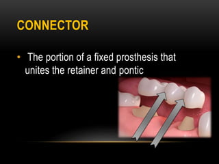 CONNECTOR
• The portion of a fixed prosthesis that
unites the retainer and pontic
 