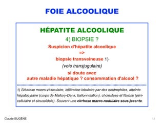 FOIE ALCOOLIQUE
HÉPATITE ALCOOLIQUE
4) BIOPSIE ?
Suspicion d'hépatite alcoolique
=>
biopsie transveineuse 1)
(voie transjugulaire)
si doute avec
autre maladie hépatique ? consommation d'alcool ?
...............................................................................................................
1) Stéatose macro-vésiculaire, infiltration lobulaire par des neutrophiles, atteinte
hépatocytaire (corps de Mallory-Denk, ballonnisation), cholestase et fibrose (péri-
cellulaire et sinusoïdale). Souvent une cirrhose macro-nodulaire sous-jacente.
Claude EUGÈNE 15
 