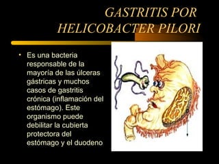 GASTRITIS POR
HELICOBACTER PILORI
• Es una bacteria
responsable de la
mayoría de las úlceras
gástricas y muchos
casos de gastritis
crónica (inflamación del
estómago). Este
organismo puede
debilitar la cubierta
protectora del
estómago y el duodeno
 