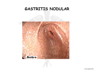 GASTRITIS NODULAR
 