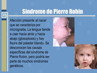 Sindrome de Pierre Robin Afección presente al nacer que se caracteriza por micrognatia. La lengua tiende a caer hacia atrás y hacia abajo (glosoptosis) y hay fisura del paladar blando. Se desconocen las causas específicas del síndrome de Pierre Robin, pero podría ser parte de muchos síndromes genéticos.  