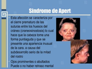 Sindrome de Apert Esta afección se caracteriza por el cierre prematuro de las suturas entre los huesos del cráneo (craneosinostosis) lo cual hace que la cabeza tome una forma puntiaguda y que se presente una apariencia inusual de la cara. a causa del subdesarrollo serio de la mitad del rostro  Ojos prominentes o abultados Puede o no haber retraso mental 
