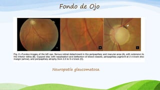 Fondo de Ojo
Neuropatía glaucomatosa.
 