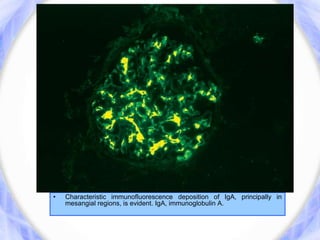 • Characteristic immunofluorescence deposition of IgA, principally in
mesangial regions, is evident. IgA, immunoglobulin A.
 