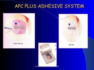 APC PLUS ADHESIVE SYSTEMAPC PLUS ADHESIVE SYSTEM
www.indiandentalacademy.com
 