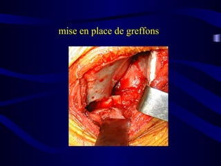 mise en place de greffons
 