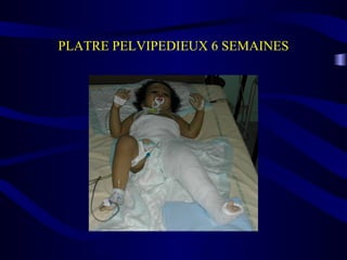 PLATRE PELVIPEDIEUX 6 SEMAINES
 