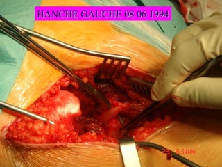 HANCHE GAUCHE 08 06 1994HANCHE GAUCHE 08 06 1994
 