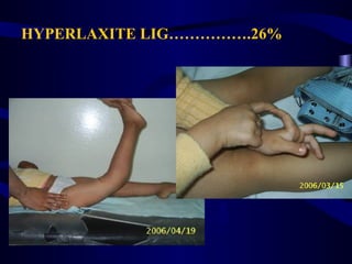 HYPERLAXITE LIG…………….26%
 