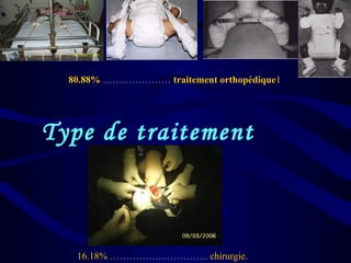 Type de traitement
16.18% ……………..………….. chirurgie.
80.88% ………………… traitement orthopédique1
 