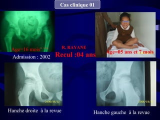 Cas clinique 01
Admission : 2002
Hanche droite à la revue Hanche gauche à la revue
Age=16 mois R. RAYANE
Recul :04 ans Age=05 ans et 7 mois
 