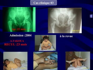 Cas clinique 03
Admission :2004 à la revue
Age :22 mois
A.TAKOUA
RECUL :23 mois
 