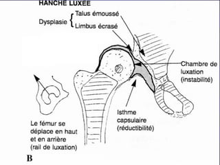 La luxation congénitale de la hanche