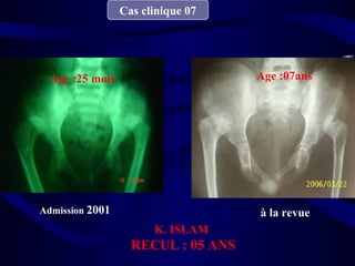 Cas clinique 07
Admission 2001 à la revue
Age :25 mois Age :07ans
K. ISLAM
RECUL : 05 ANS
 
