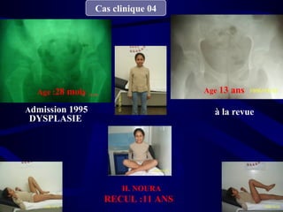Cas clinique 04
à la revueAdmission 1995
DYSPLASIE
Age :28 mois
H. NOURA
RECUL :11 ANS
Age 13 ans
 