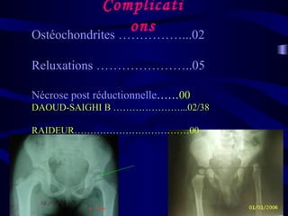Complicati
onsOstéochondrites ……………...02
Reluxations …………………..05
Nécrose post réductionnelle……00
DAOUD-SAIGHI B …………………...02/38
RAIDEUR………………………………00
 